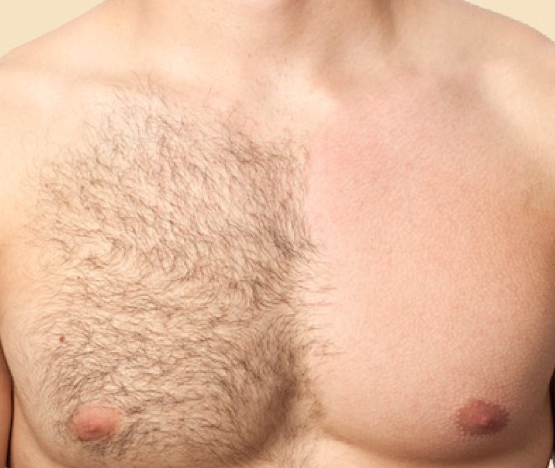 Épilation définitive