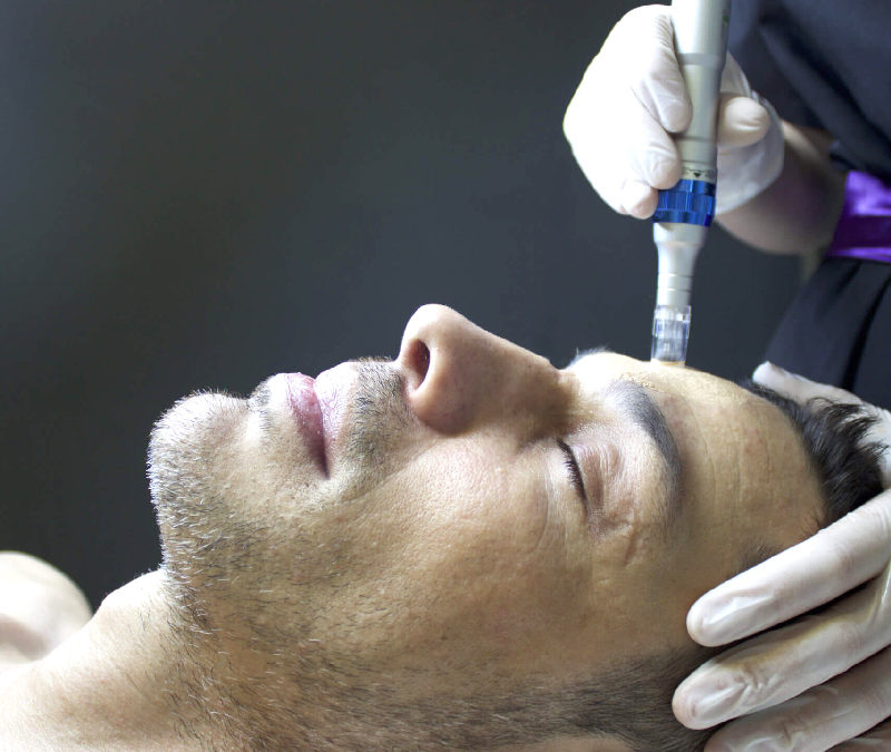 Microneedling